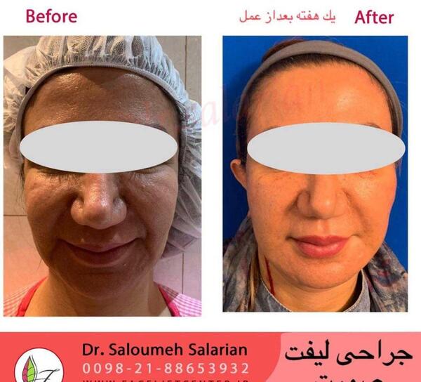عکس لیفت صورت قبل و بعد