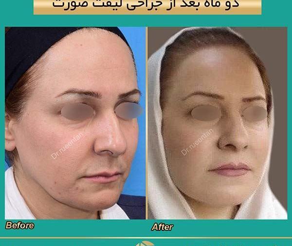 عکس لیفت صورت قبل و بعد