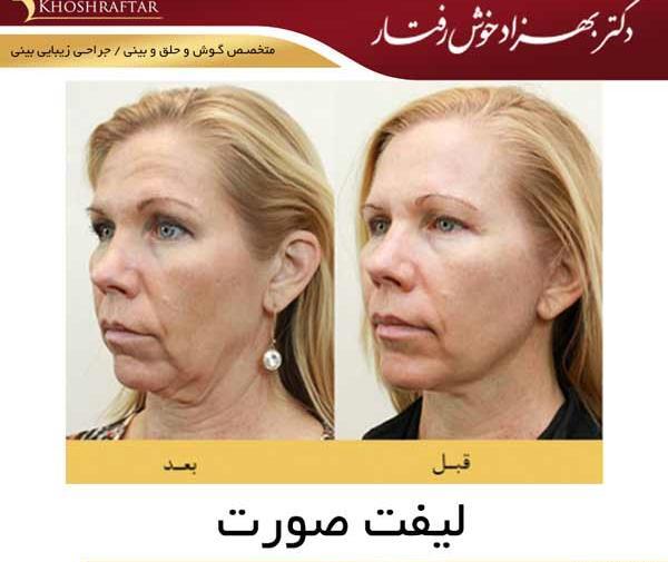 عکس لیفت صورت قبل و بعد