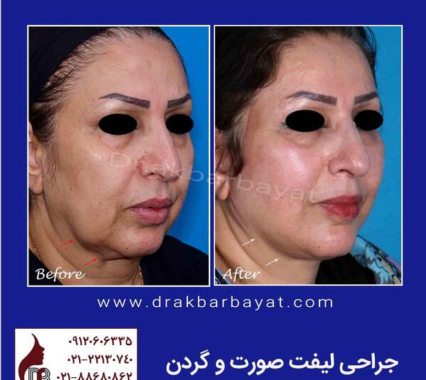 عکس لیفت صورت قبل و بعد