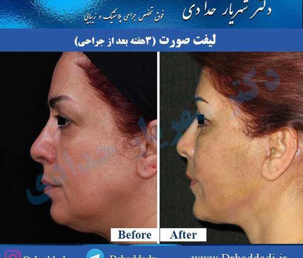 عکس لیفت صورت قبل و بعد