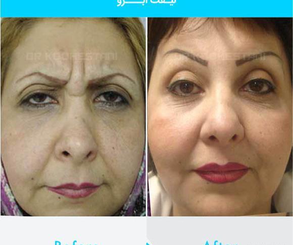 عکس لیفت صورت قبل و بعد