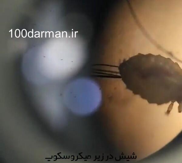 عکس شپش سر زیر میکروسکوپ