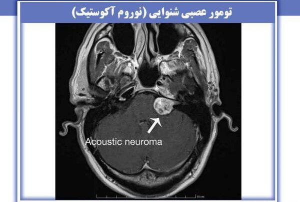 عکس ام ار ای گوش