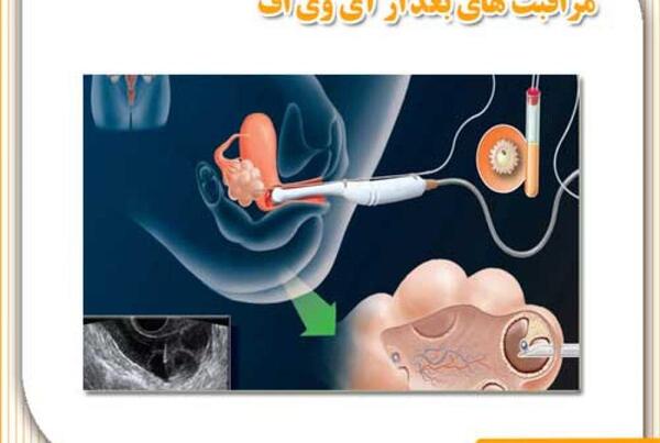عکس آی وی اف