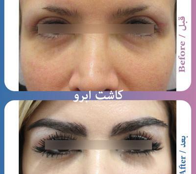 عکس کاشت ابرو روی تاتو