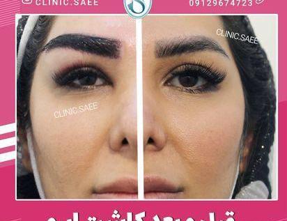 عکس کاشت ابرو روی تاتو