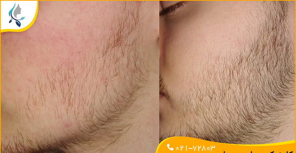 عکس ریش کم پشت