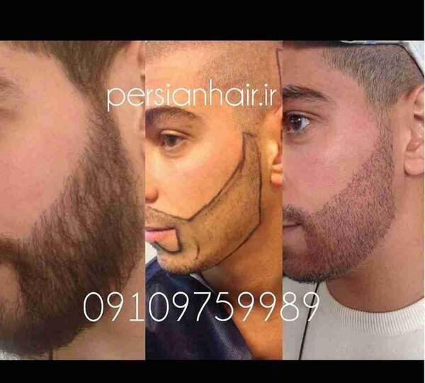عکس کاشت ریش و سبیل