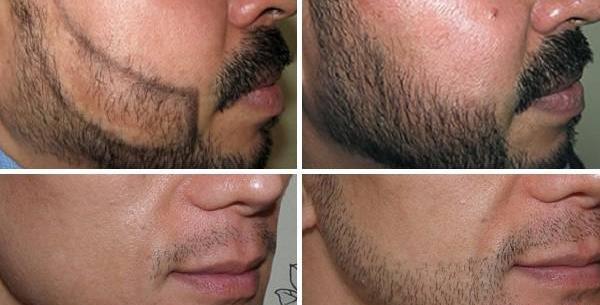 عکس کاشت ریش و سبیل