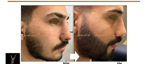 عکس کاشت ریش و سبیل
