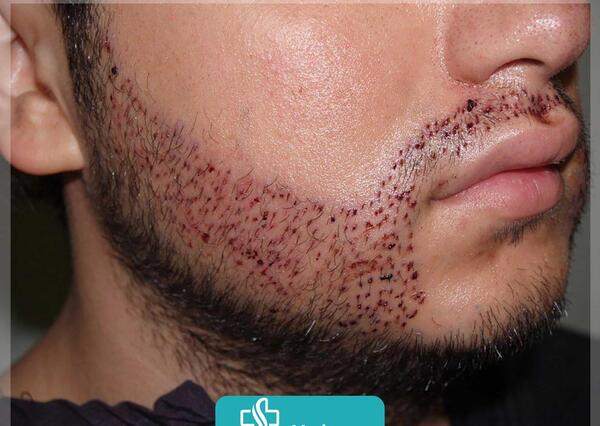 عکس کاشت ریش و سبیل