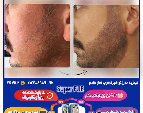 عکس کاشت ریش و سبیل
