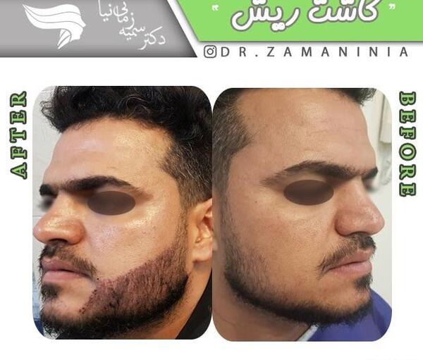 عکس کاشت ریش و سبیل