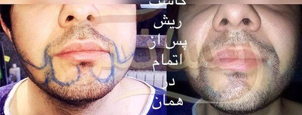 عکس کاشت ریش و سبیل