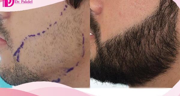 عکس کاشت ریش و سبیل
