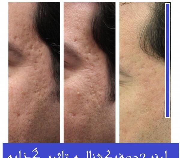 عکس قبل و بعد لیزر co2