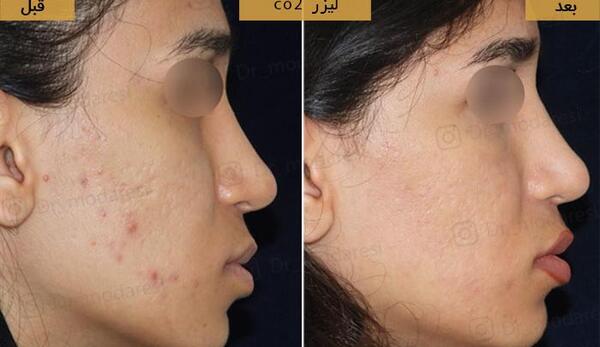 عکس قبل و بعد لیزر co2