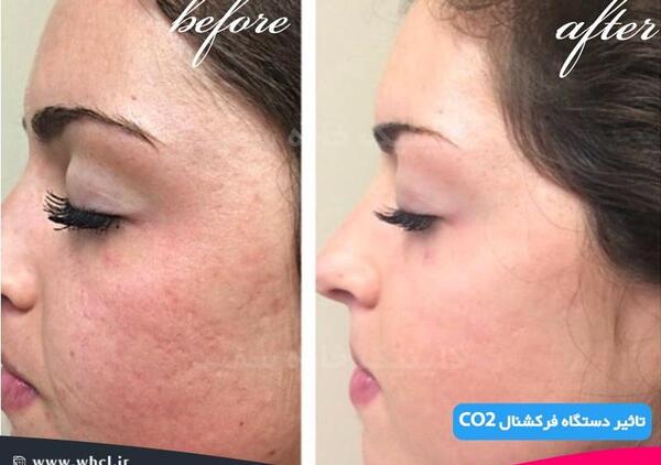 عکس قبل و بعد لیزر co2