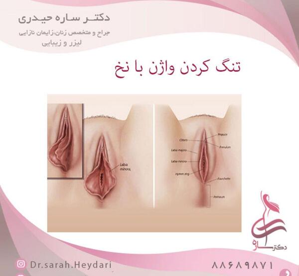 عکس تزریق ژل به واژن نی نی سایت