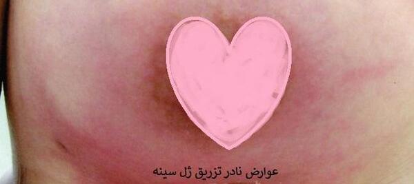 عکس تزریق ژل به واژن نی نی سایت