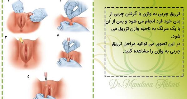 عکس تزریق ژل به واژن نی نی سایت