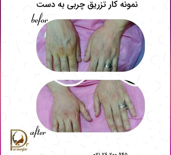 عکس تزریق ژل به واژن نی نی سایت