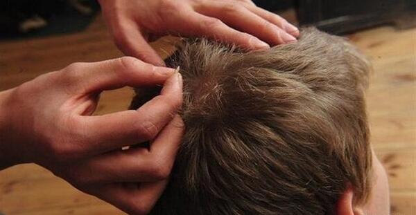عکس بزرگترین شپش سر