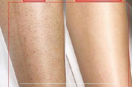 عکس لیزر موهای زائد بدن