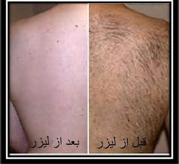 عکس لیزر موهای زائد بدن