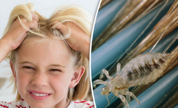 عکس شپش سر بچه