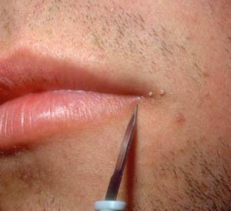 عکس ویروس hpv در زنان