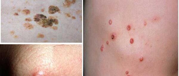 عکس ویروس hpv در زنان
