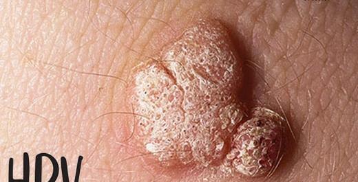 عکس ویروس hpv در زنان