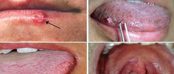 عکس ویروس hpv در زنان