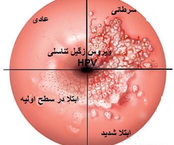 عکس ویروس hpv در زنان