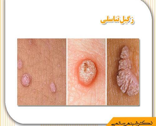 عکس ویروس hpv در زنان