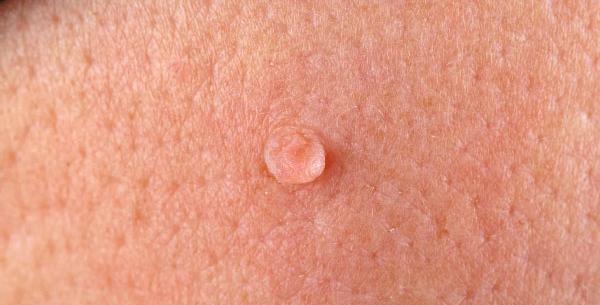عکس ویروس hpv در زنان