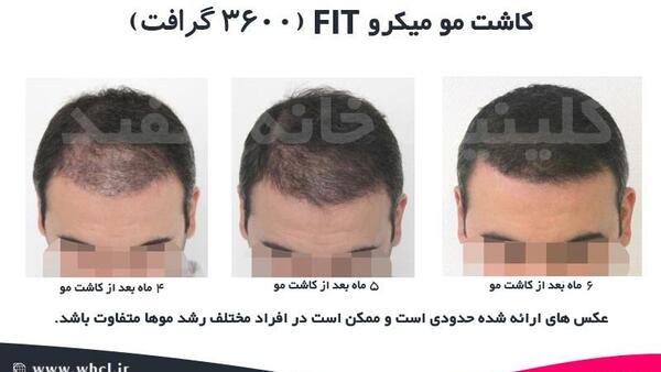 عکس کاشته شده