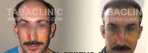 عکس کاشته شده