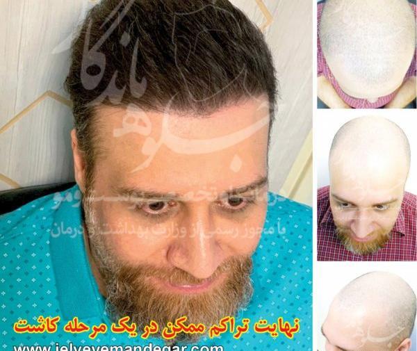 عکس چندش کاشت مو