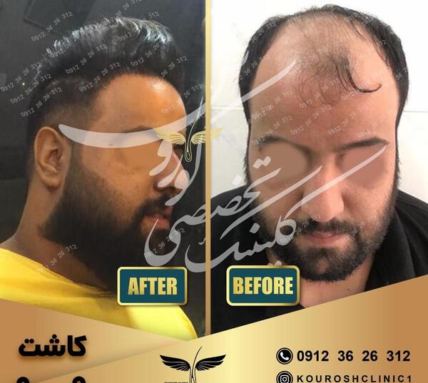 عکس چندش کاشت مو