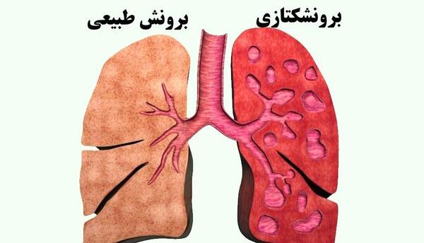 عکس ریه برونشکتازی