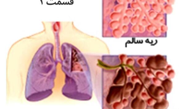 عکس ریه برونشکتازی