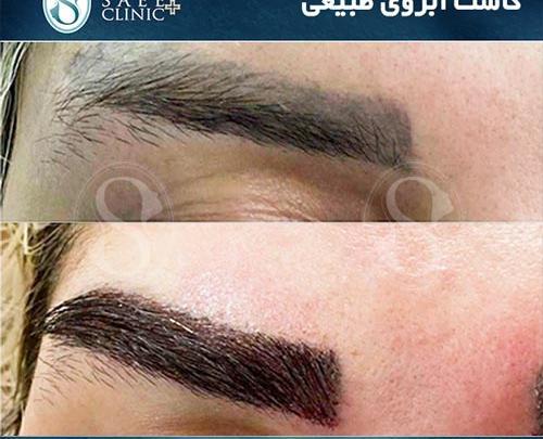 عکس کاشت ابرو بعد از یکسال