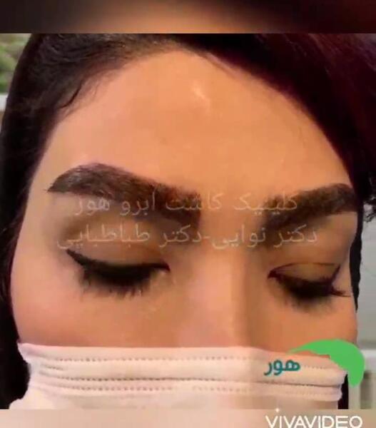 عکس کاشت ابرو بعد از یکسال