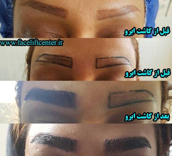 عکس کاشت ابرو بعد از یکسال
