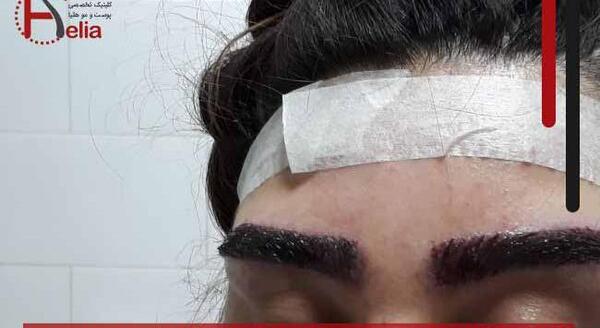 عکس کاشت ابرو بعد از یکسال
