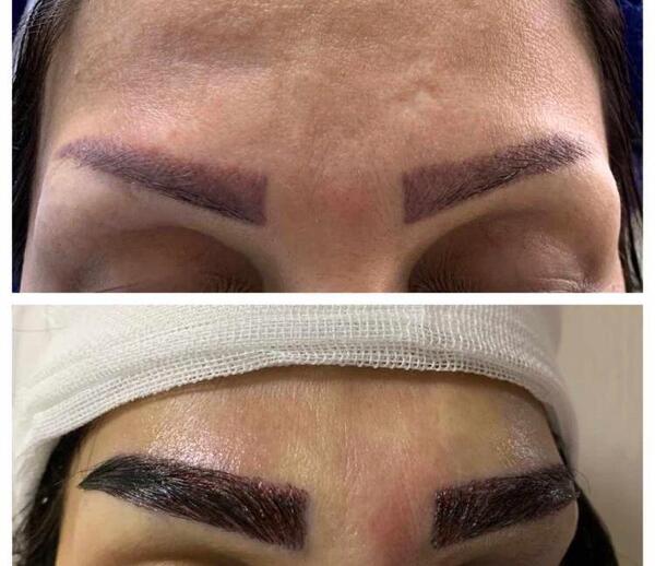 عکس کاشت ابرو بعد از یکسال