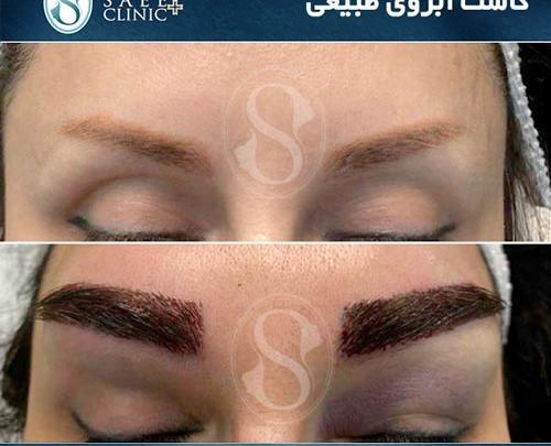 عکس کاشت ابرو بعد از یکسال